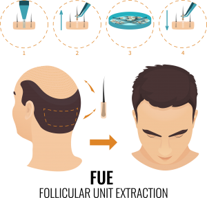 Etapele transplantului de par - Metoda FUE