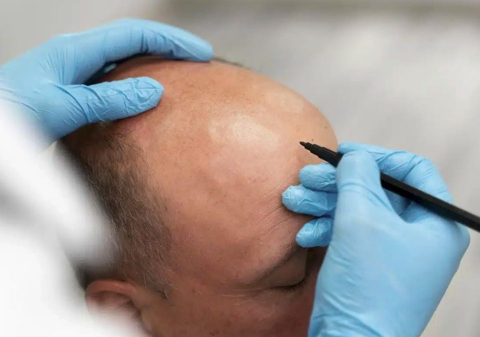 inainte de procedura de implant de par