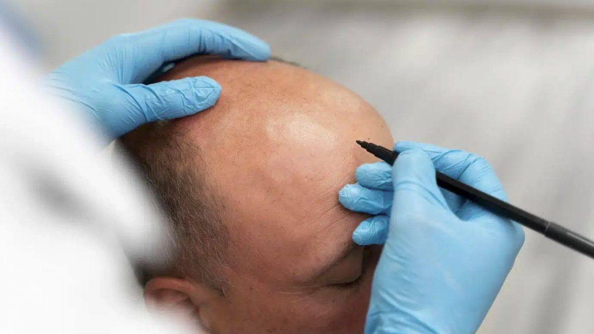 inainte de procedura de implant de par